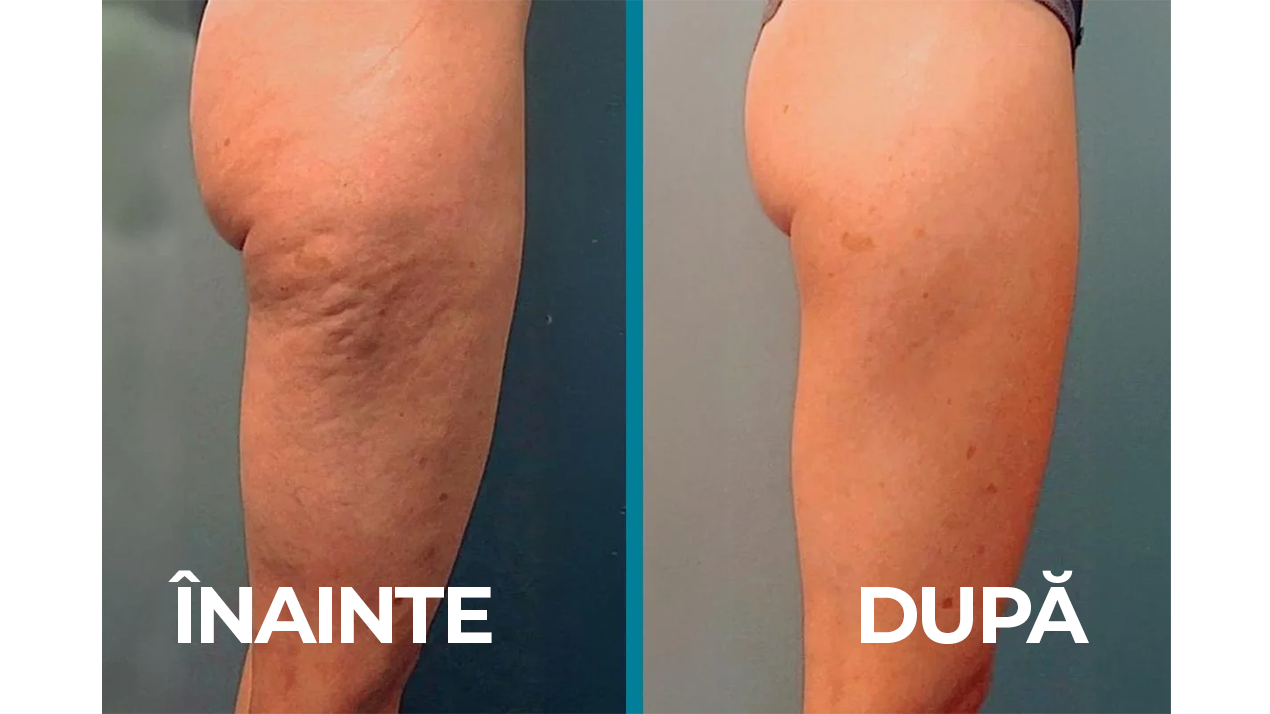 Cremă  braziliană remodelatoare 3 în 1